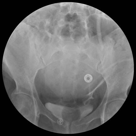 Ureteric injury | Radiology Reference Article | Radiopaedia.org