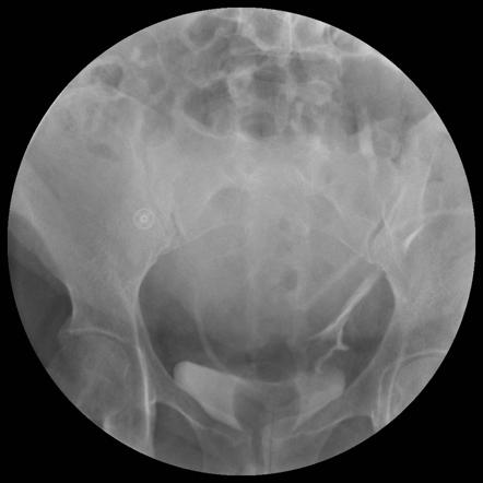 Ureteric injury post cesarean section | Radiology Case | Radiopaedia.org