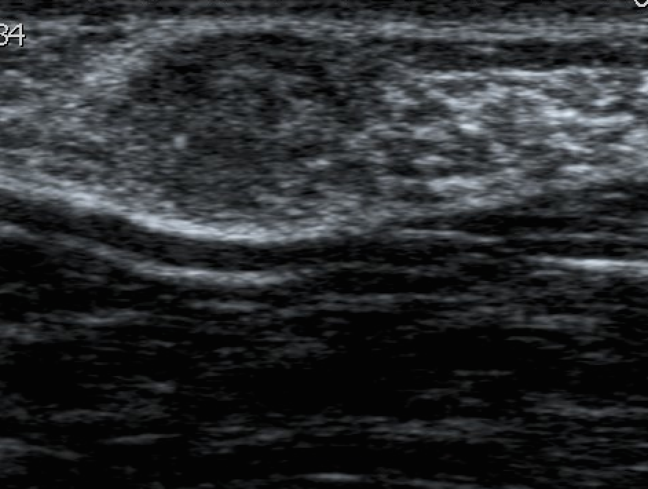 Infiltrating ductal carcinoma of the breast | Image | Radiopaedia.org