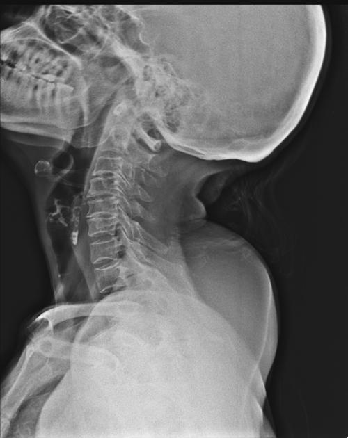 Lipoma | Radiology Reference Article | Radiopaedia.org