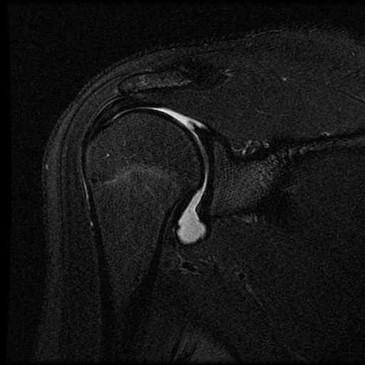 Normal Shoulder Mri Arthrogram