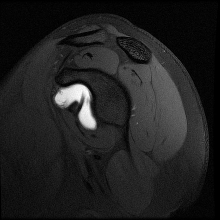 MRI of the shoulder (an approach) | Radiology Reference Article ...