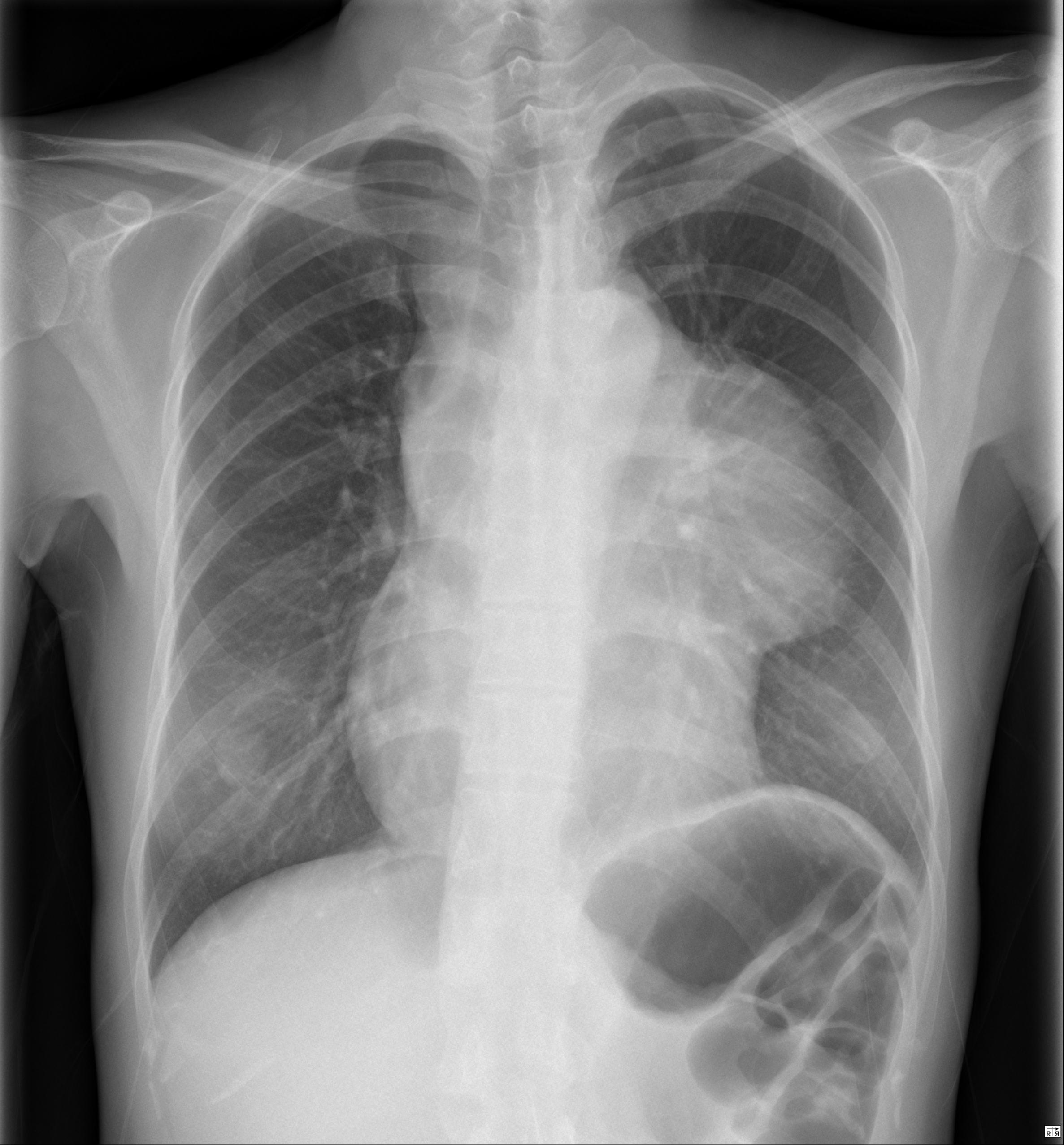 Anterior mediastinal lymphoma | Image | Radiopaedia.org