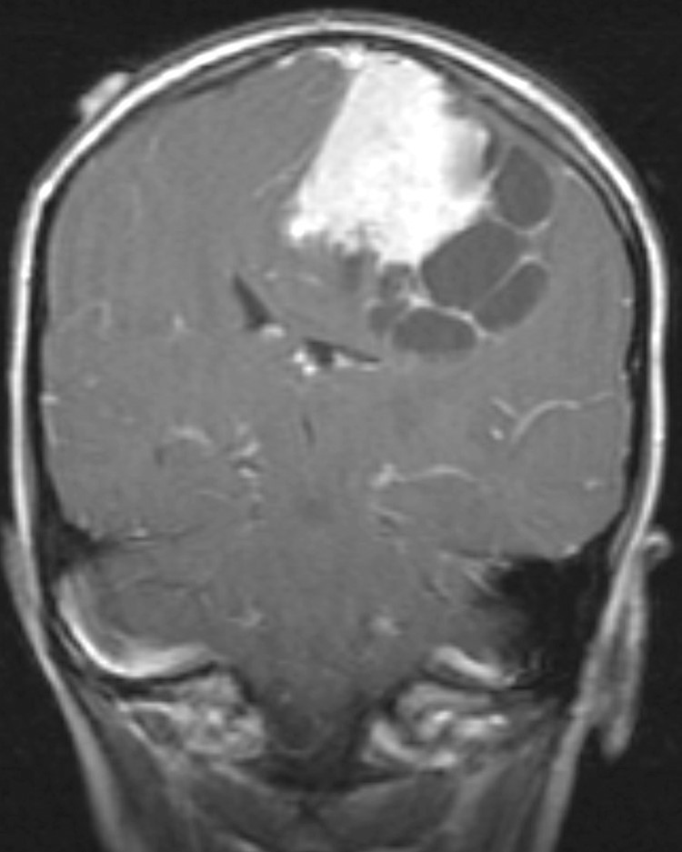 Meningioma - cystic | Image | Radiopaedia.org