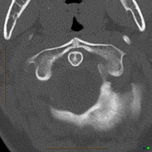 Unfused anterior arch of the atlas (in a child) | Radiology Case 