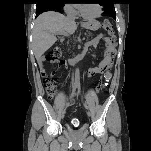 Colocutaneous fistula in Crohn's disease Image