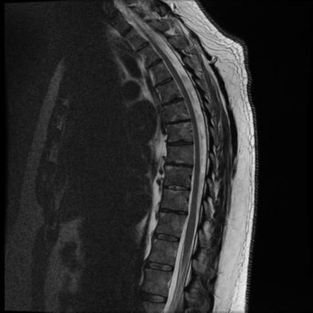 Schmorl node - acute | Image | Radiopaedia.org