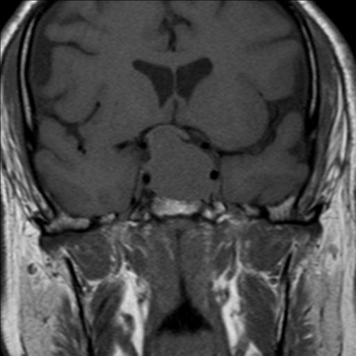 Invasive Gonadotroph Cell Pituitary Adenoma Image 5134