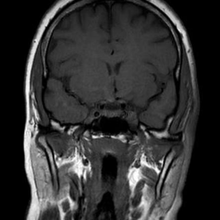 Tolosa-Hunt syndrome | Image | Radiopaedia.org