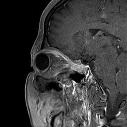 Tolosa-Hunt syndrome | Image | Radiopaedia.org