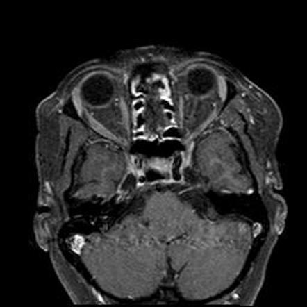 Tolosa-Hunt syndrome | Image | Radiopaedia.org