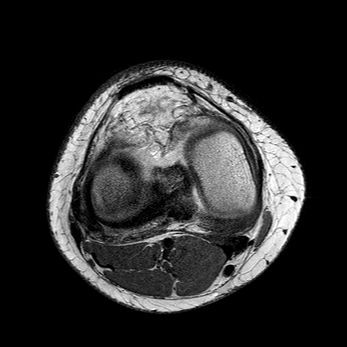 Torn discoid lateral meniscus | Image | Radiopaedia.org