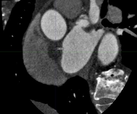 Lipomatous Hypertrophy Of The Interatrial Septum Radiology Reference