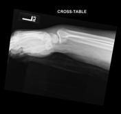 Smith Fracture Radiology Reference Article Radiopaedia Org