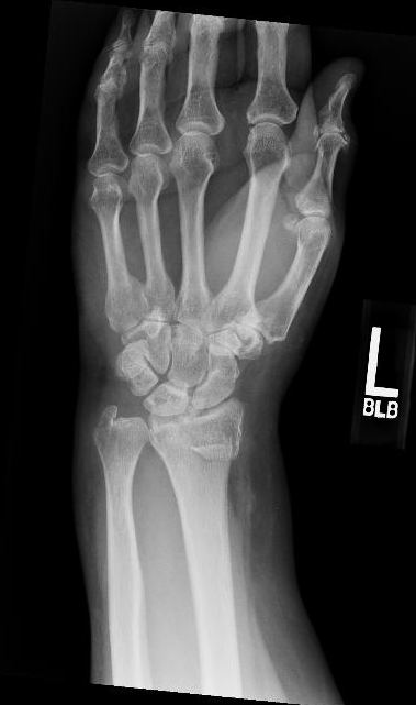 Smith fracture | Image | Radiopaedia.org