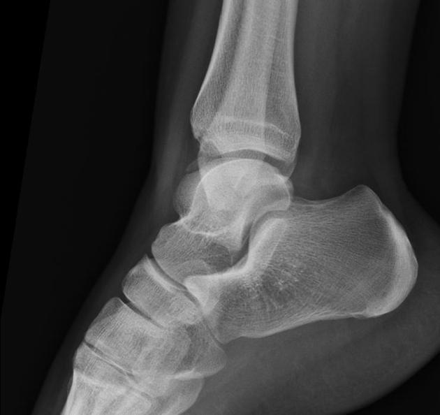 Osteochondritis dissecans of the ankle