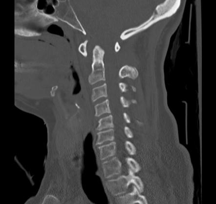 Atlanto-axial subluxation | Radiology Reference Article | Radiopaedia.org