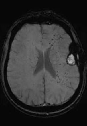 High-resolution 3D T1-weighted turbo fi eld echo imaging of the brain.