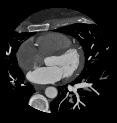 Patent Foramen Ovale Image