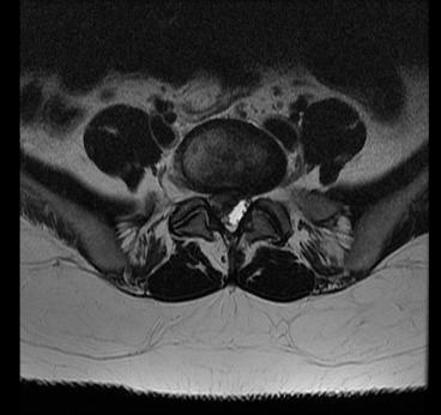 Lumbar disc disease - extrusion | Image | Radiopaedia.org