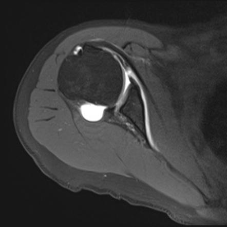 Glenoid hypoplasia | Radiology Reference Article | Radiopaedia.org