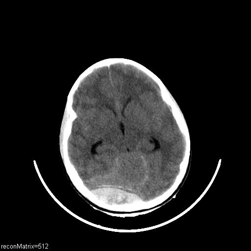 Extradural hematoma - venous | Image | Radiopaedia.org