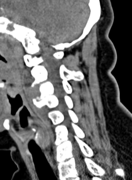 Tuberculous Spondylodiscitis | Image | Radiopaedia.org