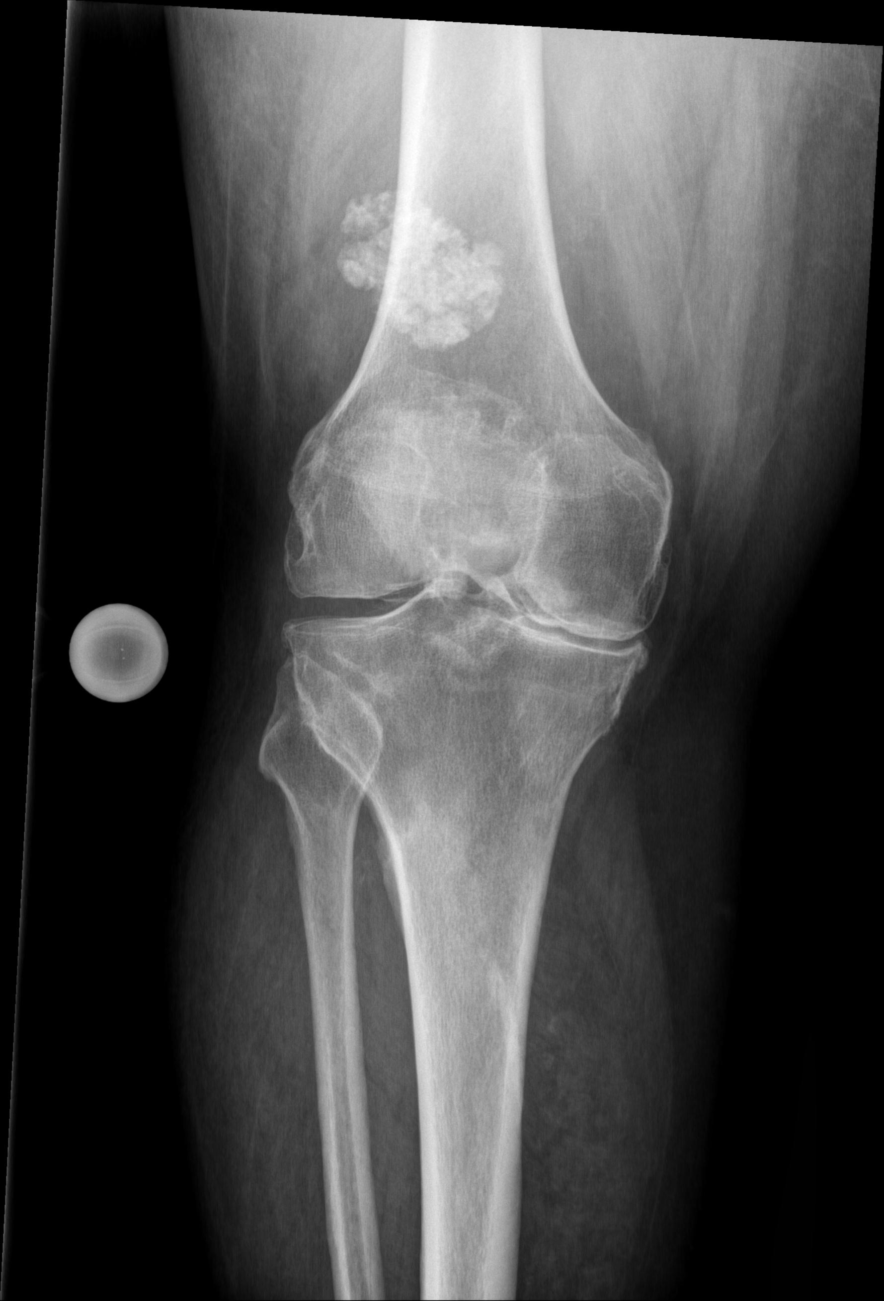 Osteoarthritis of knee with suprapatellar intra-articular loose body ...