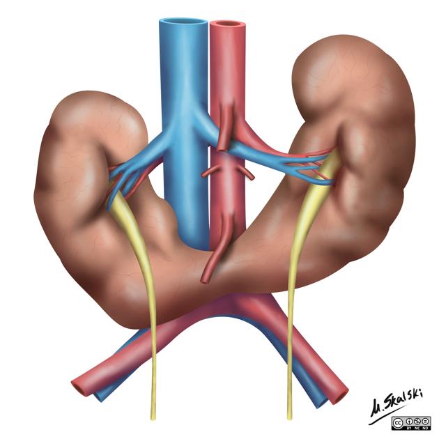 Horseshoe kidney, Radiology Reference Article