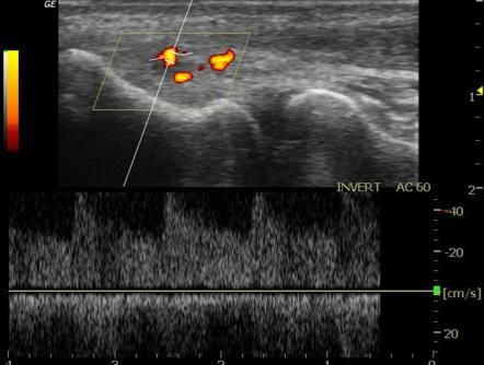 Lateral epicondylitis | Image | Radiopaedia.org