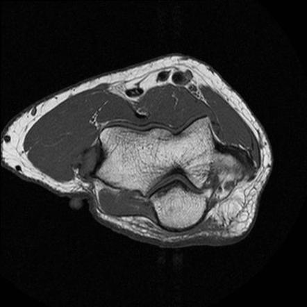 Lateral Epicondylitis Mri