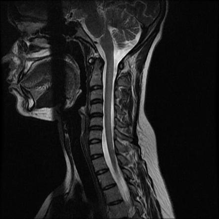 Subacute combined degeneration of cord - vitamin B12 deficiency | Image ...