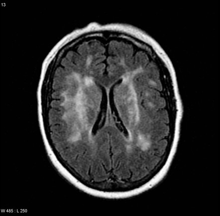 Susac syndrome | Radiology Reference Article | Radiopaedia.org