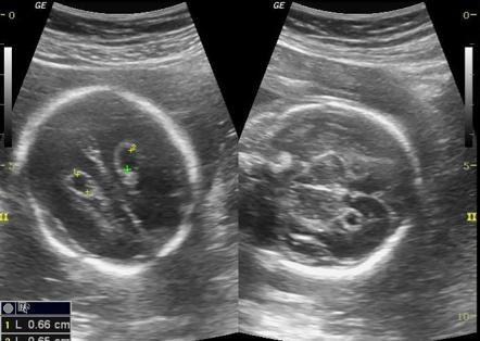 Choroid Plexus Cyst (antenatal) | Radiology Reference Article ...