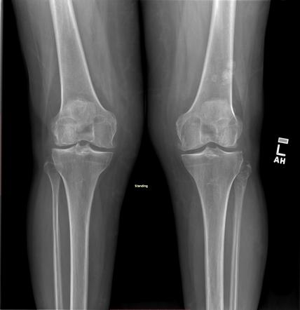 Secondary synovial osteochondromatosis and enchondroma | Radiology Case ...