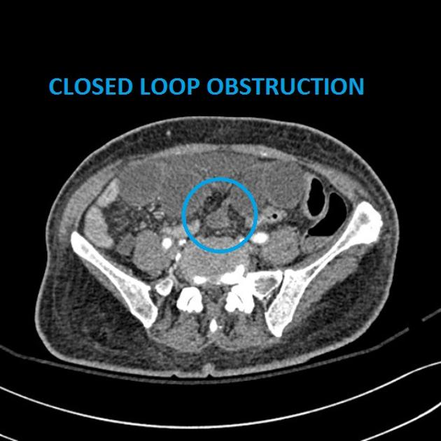 Closed loop obstruction Radiology Reference Article