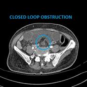 Closed Loop Syndrome