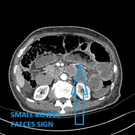 Ischemic bowel | Image | Radiopaedia.org