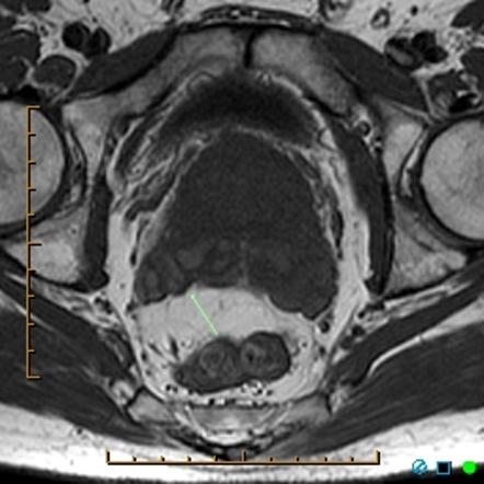 Transrectal ultrasound–guided prostate biopsy | Radiology Reference ...