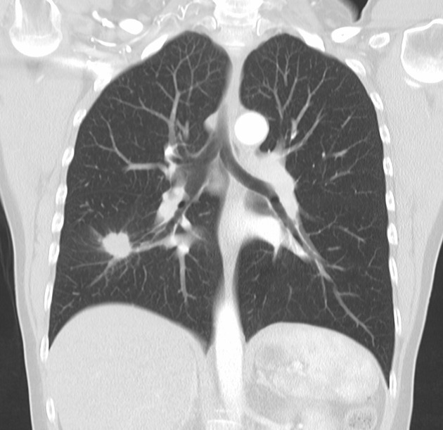 Coin lesion lung adenocarcinoma Radiology Case Radiopaedia