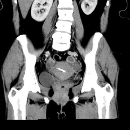 Corpus Luteal Cyst Radiology Reference Article Radiopaedia Org