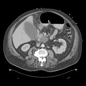 Gallbladder perforation | Radiology Reference Article | Radiopaedia.org