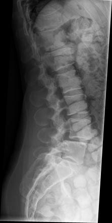 Absent pedicle sign (breast cancer metastases) | Image | Radiopaedia.org