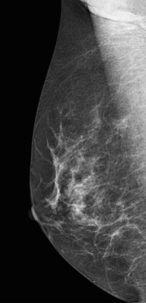 Intraductal carcinoma as a developing mass | Image | Radiopaedia.org