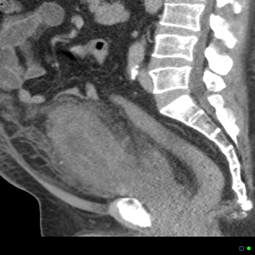 symptoms-of-cystitis-medizzy