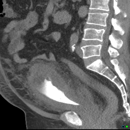 hemorrhagic-cystitis-image-radiopaedia