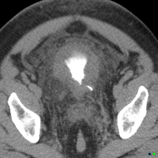 hemorrhagic-cystitis-image-radiopaedia