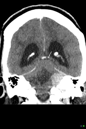 Upward transtentorial herniation due to cerebellar metastasis ...