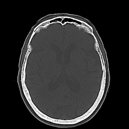 Senile calcific scleral plaques | Image | Radiopaedia.org