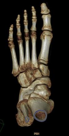 left calcaneonavicular coalition icd 10